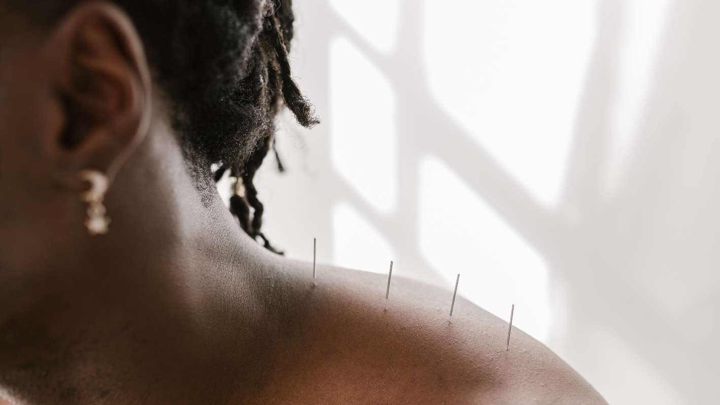 Lady with acupuncture needles