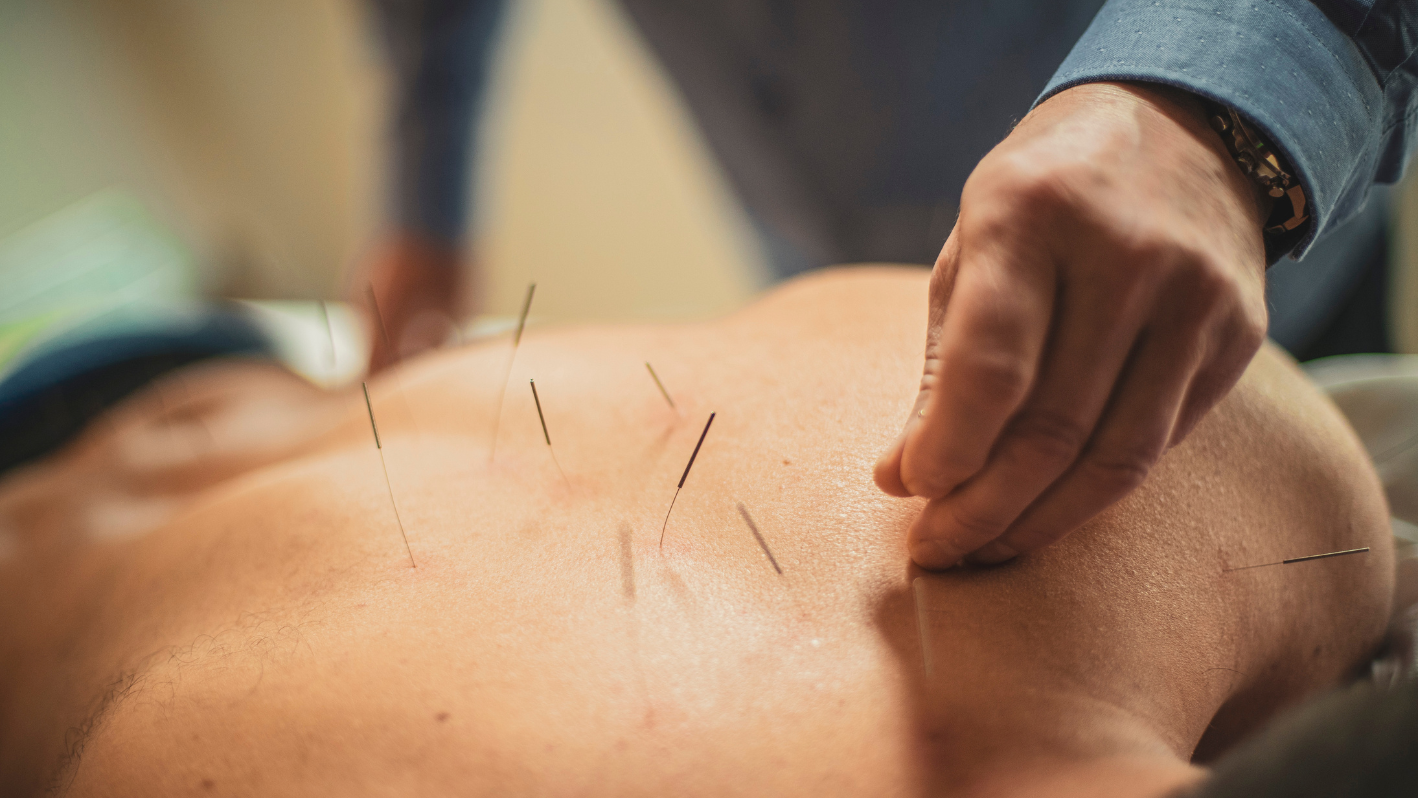 A man getting a back massage with needles on his back