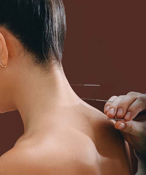 Acupuncture picture